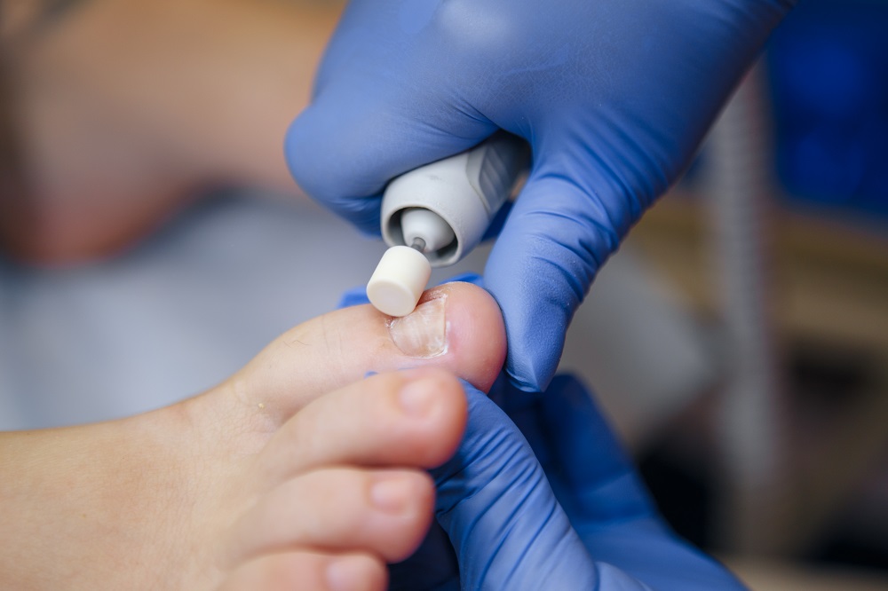 Ingrown Toenail Clinics