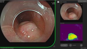 NEC's AI Supports Doctors to Detect Neoplasia