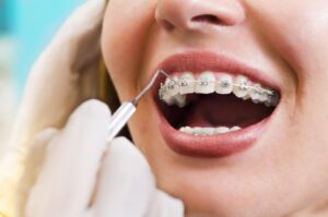 All About Braces