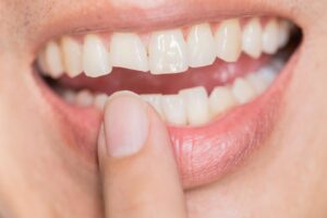 Tooth Repair 101