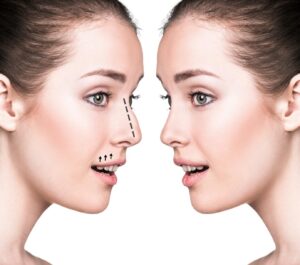 Nose Jobs