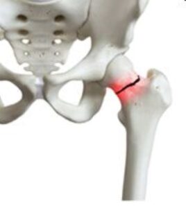 The APCO Bone Health QI Tool Kit - Putting