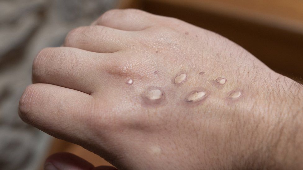 Seegene develops monkeypox PCR test